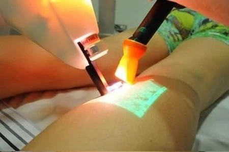 Sessão de laser transdérmico em vasos da perna, na Clínica AngioGold.